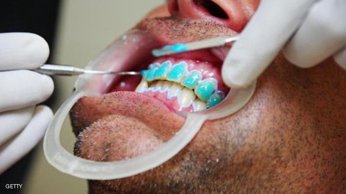 Implantes dentales